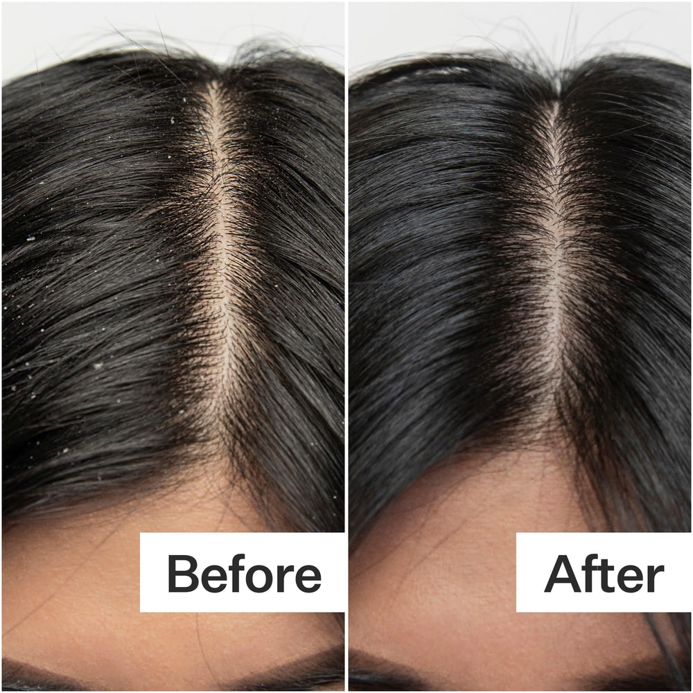 ACT+ ACRE label close-up highlighting salicylic acid and papaya extract
