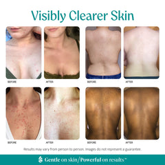 Almond Clear applied to back to treat body acne and reduce folliculitis inflammation