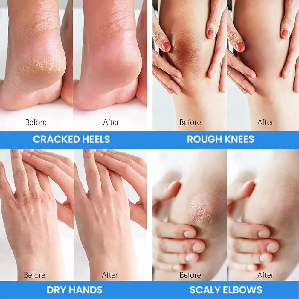 BERVEAL applied to feet with socks for overnight intensive hydration