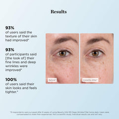 Beverly Hills MD before and after crease reduction demonstration benefit