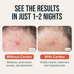 Cardon adhesive patch applied to cheek for overnight blemish treatment