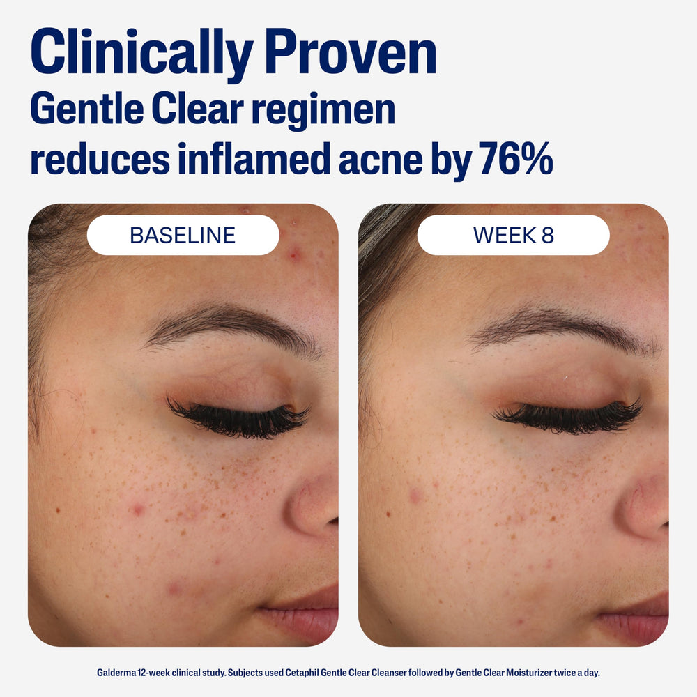 Cetaphil bottle next to cleanser suggesting gentle daily acne-care routine