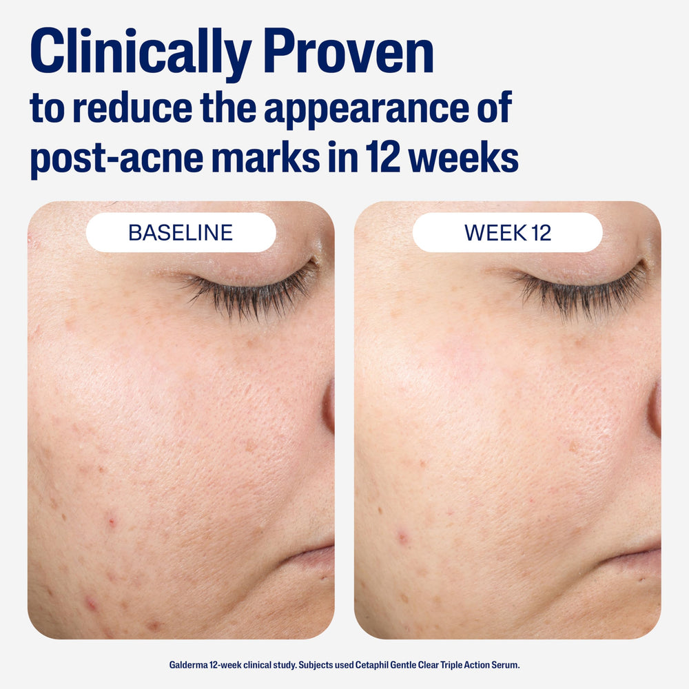 Cetaphil zinc ingredient close-up showing oil-absorbing benefit and matte finish