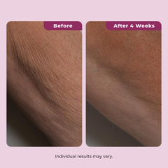 DEKLIDERM used on décolleté to reduce crepey texture and even skin tone