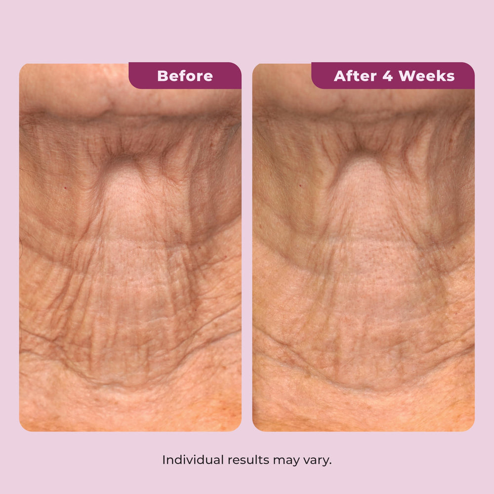 DEKLIDERM applied to upper arm showing improved firmness and softness