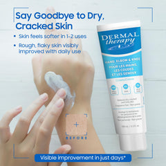 Dermal Therapy being applied to hands to deeply hydrate and soften rough skin