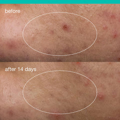 Dermalogica invisible patch formed on skin showing breathable protection benefit