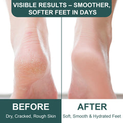 Devyonder applied to heel demonstrating callus softening benefit