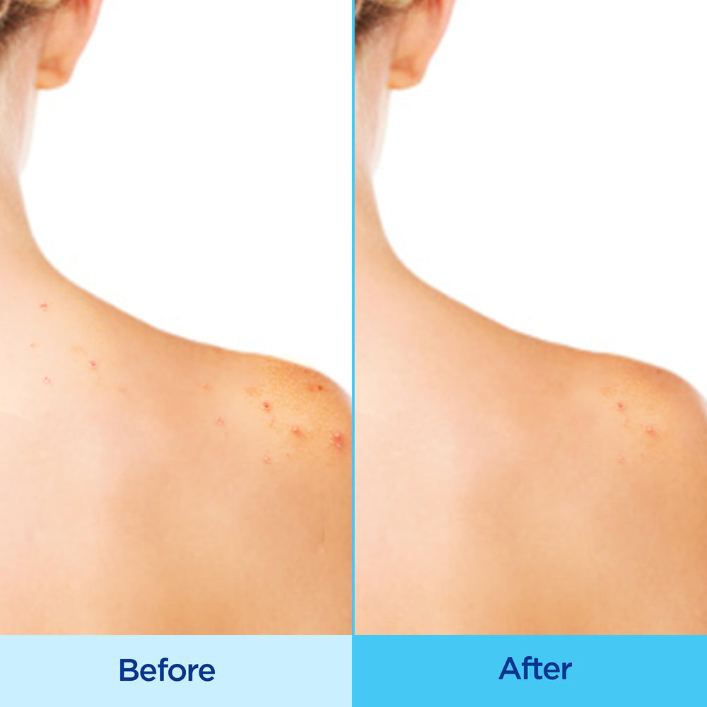 Differin spray texture on skin highlighting fast-drying, non-greasy finish
