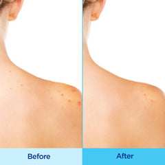 Differin spray texture on skin highlighting fast-drying, non-greasy finish