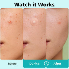 Close-up of Dr.patch hydrocolloid texture demonstrating thin edge