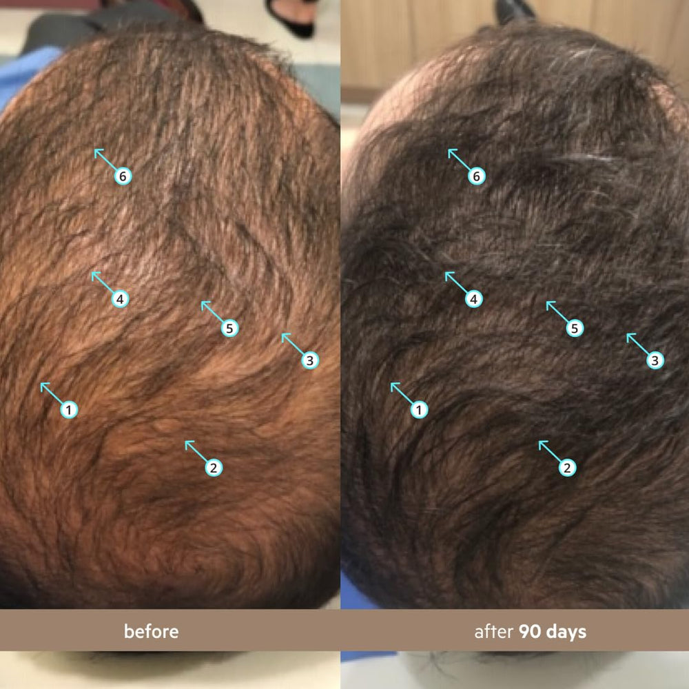 DS Laboratories application demo on scalp targeting thinning areas