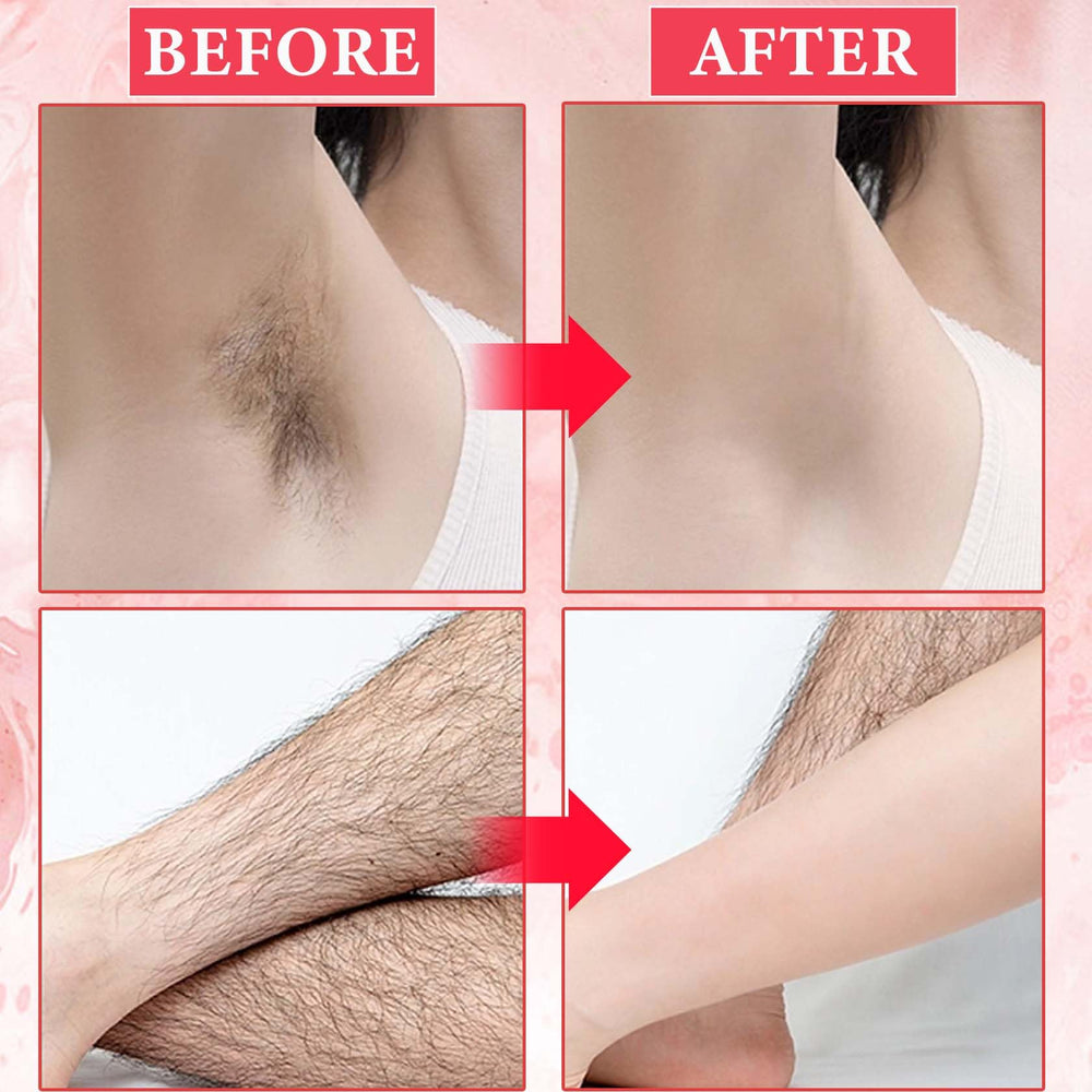 DuoZeng applied during IPL device treatment for comfort benefit