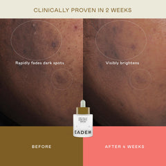 EADEM Milk Marvel applied to cheek, illustrates targeted dark spot coverage benefit