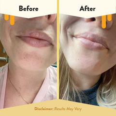 ECZEMA HONEY balm being applied on lips demonstrating soothing hydration