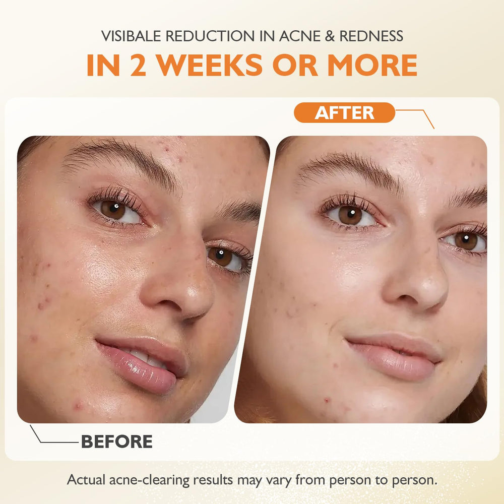 elesysy back treatment lifestyle image showing product treating body acne