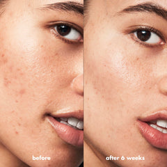 e.l.f. product in use on chin spot illustrating easy no-touch application for fast treatment