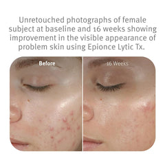 Epionce Lytic Tx texture spread on hand demonstrating lightweight hydrating feel