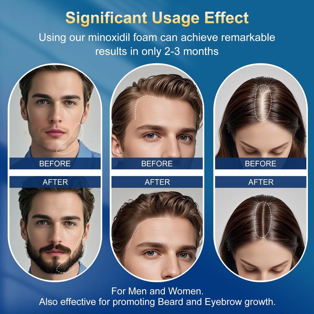 Exdeploy label and ingredients detail highlighting biotin and 5% minoxidil info