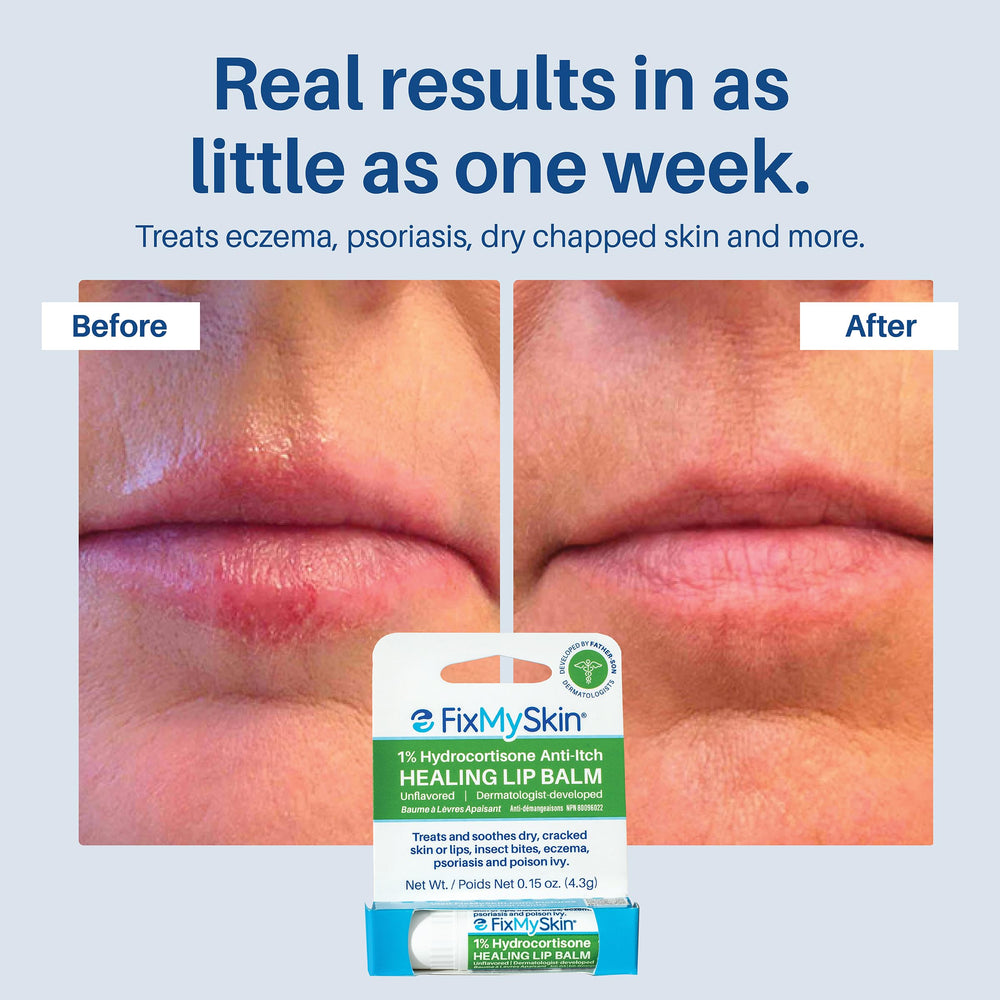 FixMySkin ingredient label highlighting 1% hydrocortisone for inflammation relief benefits