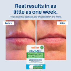 FixMySkin ingredient label highlighting 1% hydrocortisone for inflammation relief benefits