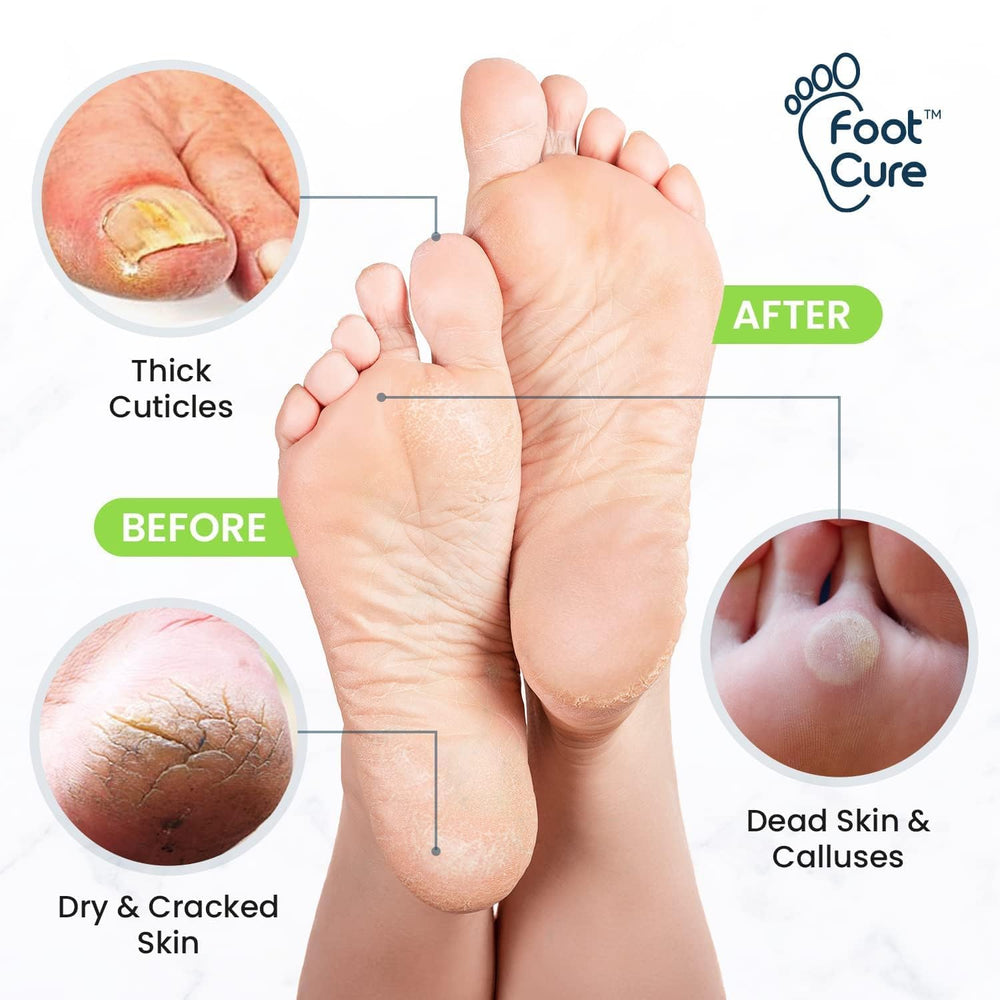 FOOT CURE applying callus gel to heel demonstrating easy targeted treatment