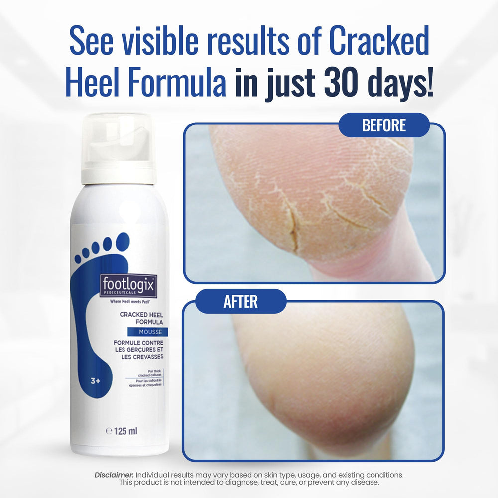 FOOTLOGIX being applied to heel showing precise targeted hydration