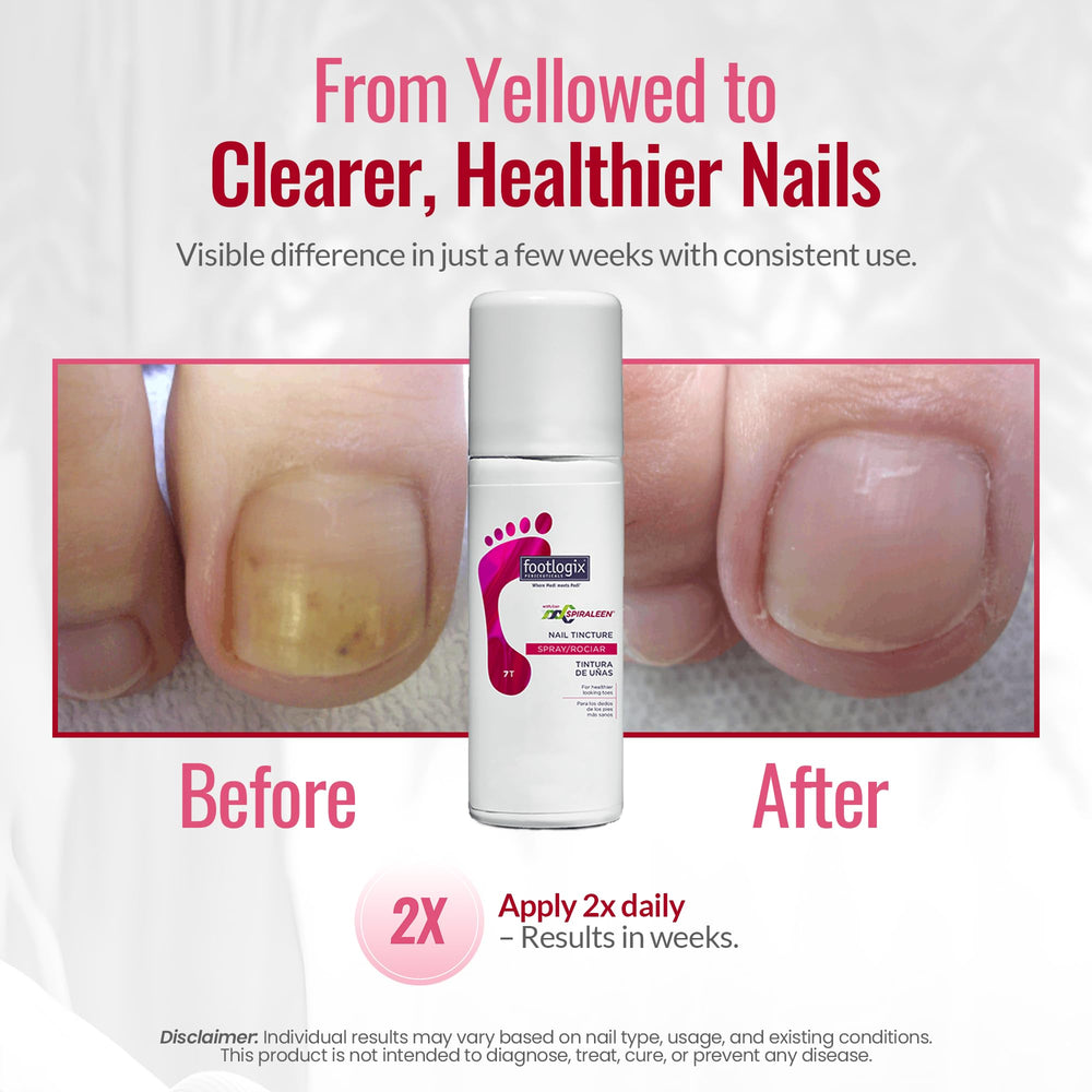 FOOTLOGIX being sprayed onto a toenail showing easy, neat application benefit