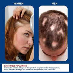 Generic alopecia cream application in hand demonstrating simple, controlled dosing benefit