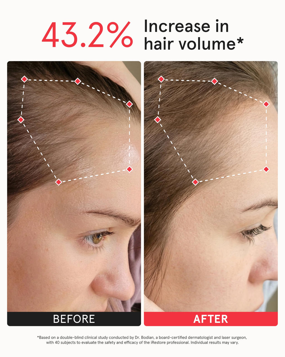 iRestore side profile illustrating full scalp coverage across hairline
