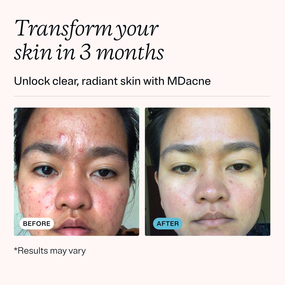 MDacne salicylic acid cleanser pump dispensed foam gently clearing pores