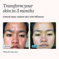 MDacne salicylic acid cleanser pump dispensed foam gently clearing pores