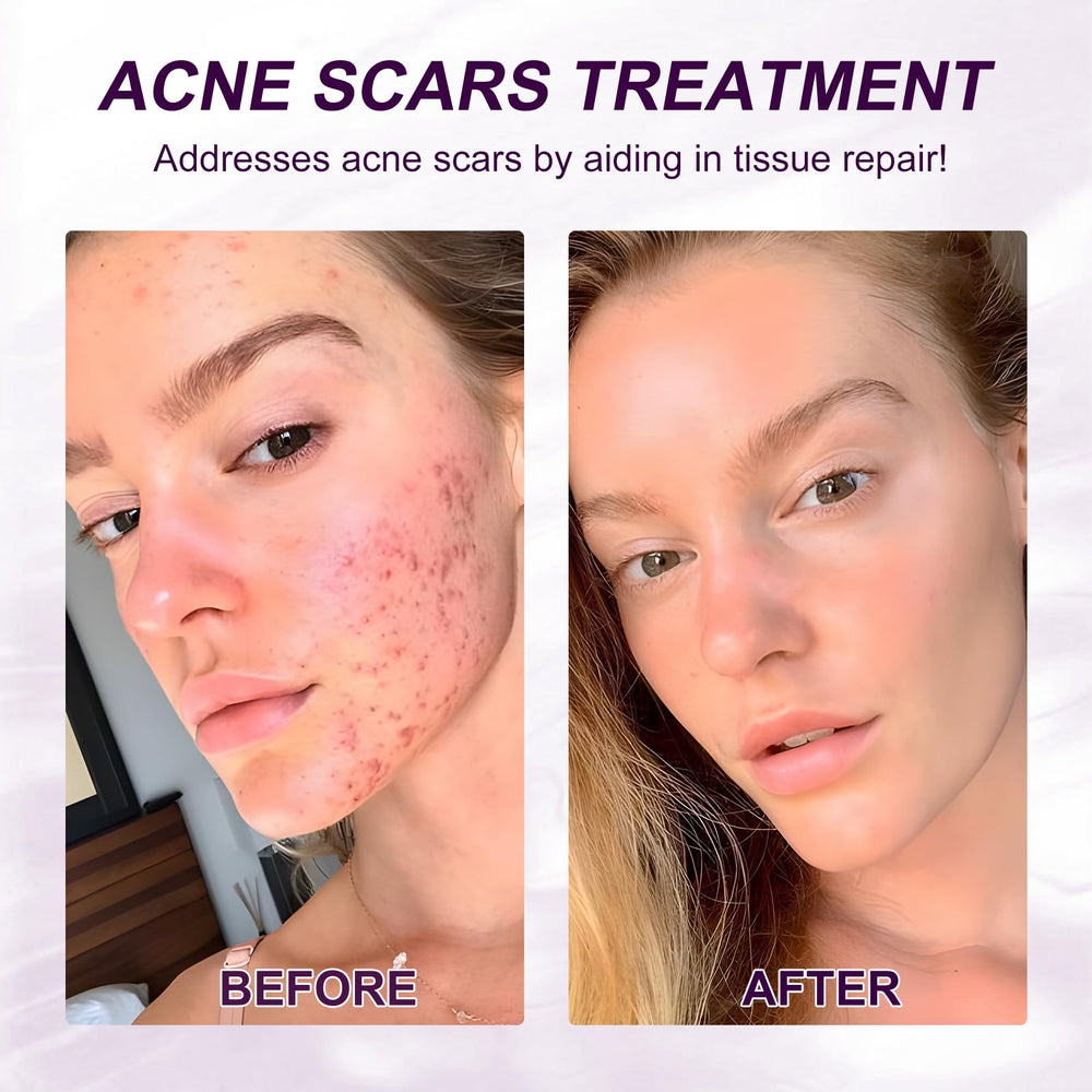 Netwik ingredient list close-up highlighting azelaic acid and niacinamide benefits