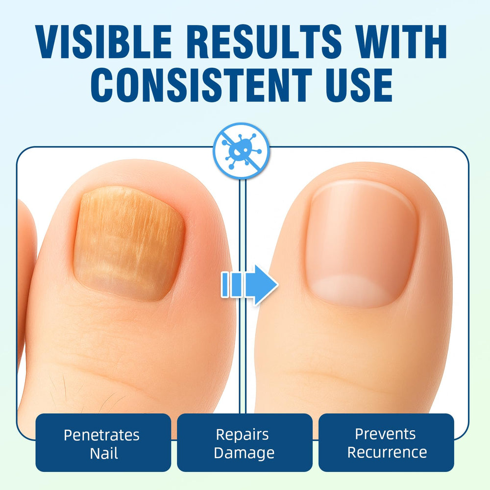 Nexkayee applied on toenail close-up, improves nail surface appearance