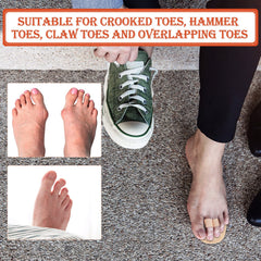 Nuanchu splint worn on foot in daily setting providing comfortable support