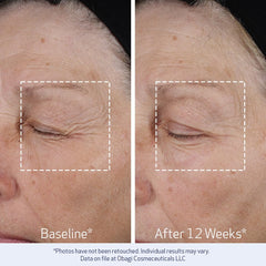 Obagi ELASTIderm being applied to jawline, demonstrates lifting and sculpting benefit