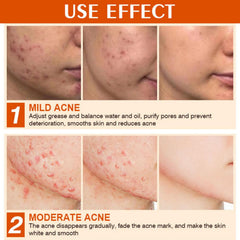 Applying Onkessy to blemish for targeted relief and reduced redness