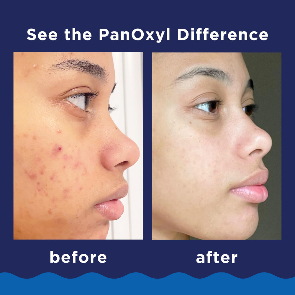 PanOxyl travel size in hand highlighting portability and convenience