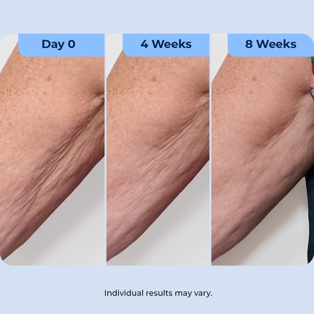 Plexaderm being applied to neck demonstrating targeted use and improved texture