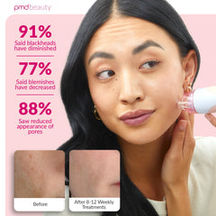 PMD Beauty handheld microdermabrasion in use on cheek for smoother texture