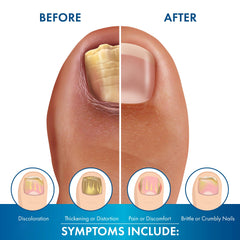 ProClearz before and after comparison showing reduced discoloration and improved nails