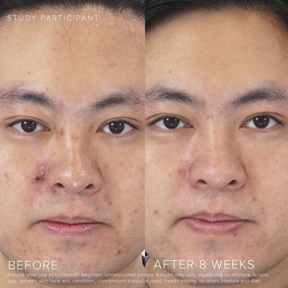 Rodan + Fields applied to cheek area illustrating targeted blemish coverage and controlled dosing