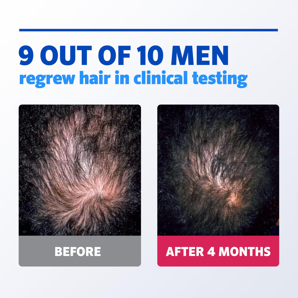Rogaine application on scalp demonstration targeting thinning area for effective delivery