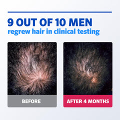 Rogaine application on scalp demonstration targeting thinning area for effective delivery