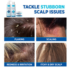 Roycederm cream applied to scalp showing spot treatment for irritated patches
