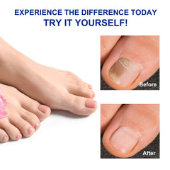 Ruduwu before and after nails comparison illustrating improved texture and appearance