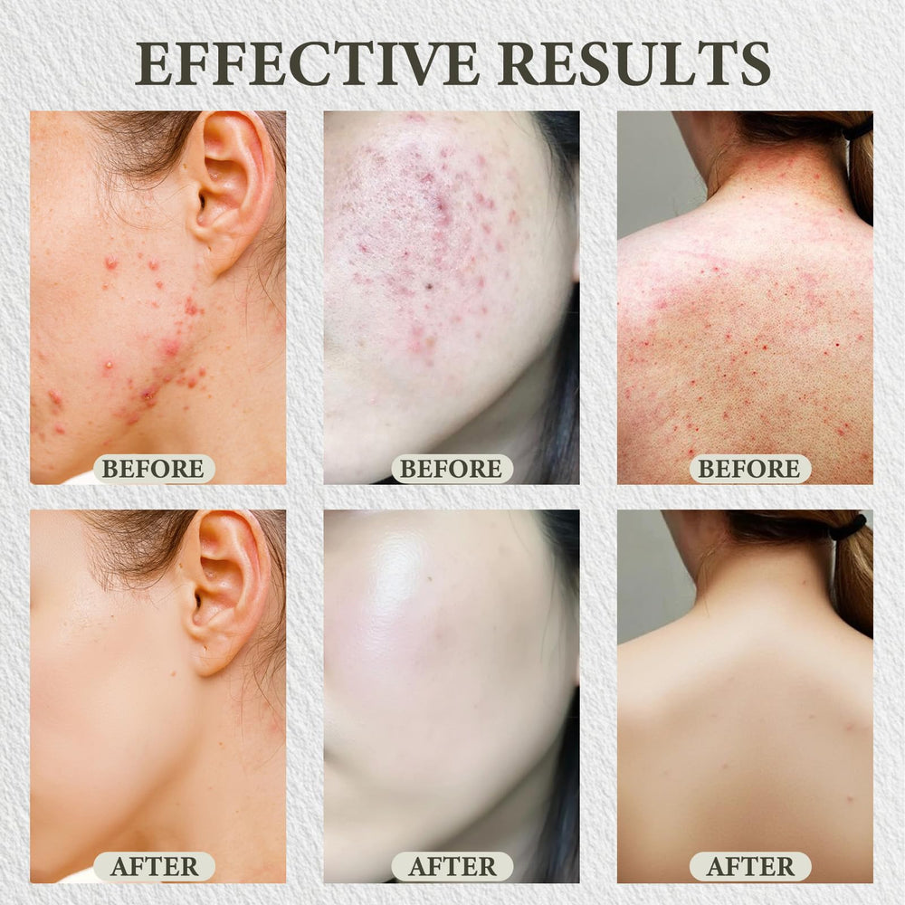 SDXJIOGE applying balm to jawline spot to reduce redness