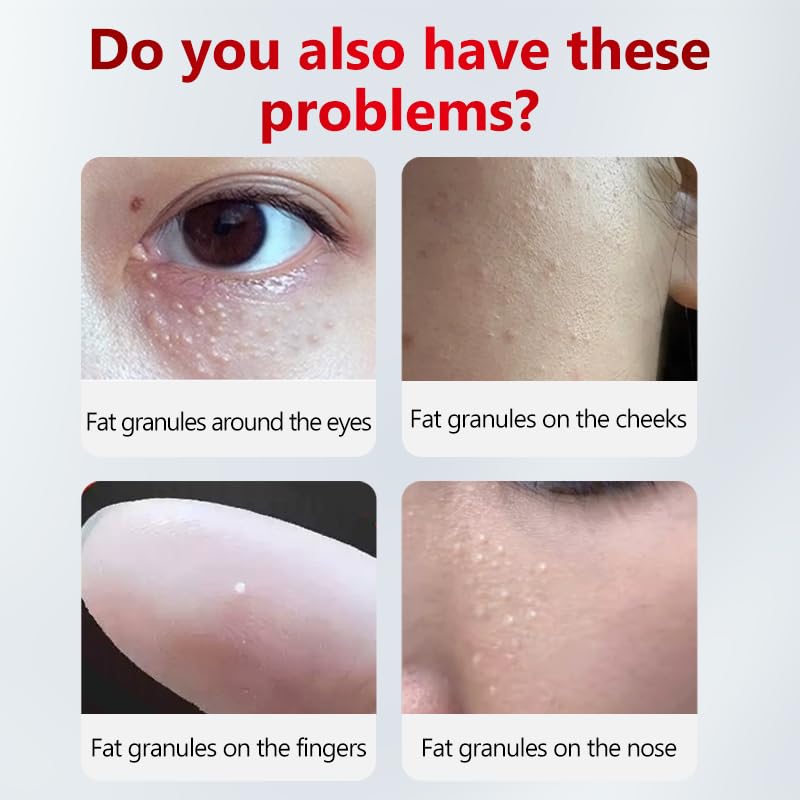 SERYNTH applying a small dot under eye for targeted milia care benefit