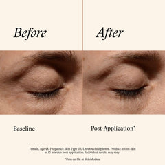 Applying SkinMedica eye cream under eye showing quick absorption benefit