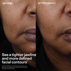 StriVectin smoothing jawline and cheek to show improved contour and tone